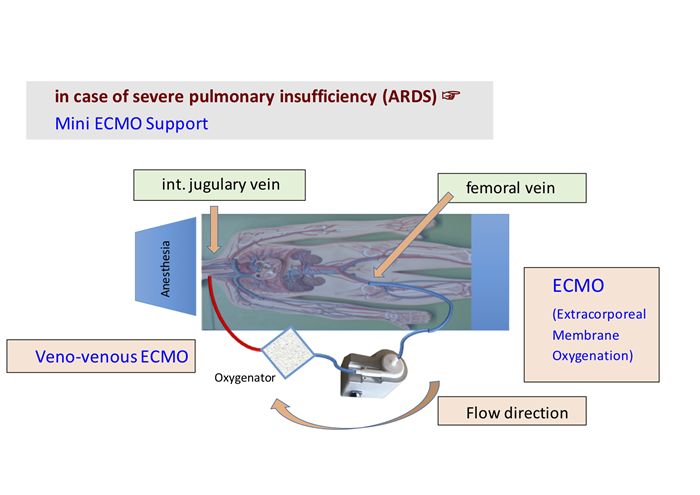 01138_02_mini-ecmo-image